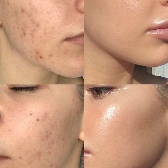 Stem Cell Microneedling Package (4) at NATURAL CARE DOC - Holistic Medspa in Phoenix, AZ