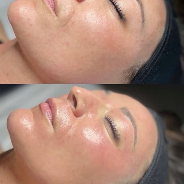 Salmon DNA Facial Package (4) ✨ at NATURAL CARE DOC - Holistic Medspa in Phoenix, AZ