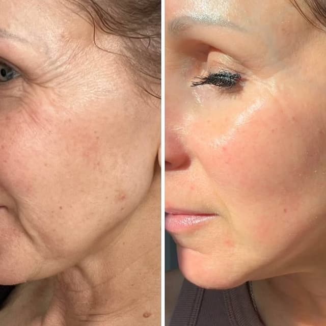 Microneedling Facial Package (4) at NATURAL CARE DOC - Holistic Medspa in Phoenix, AZ